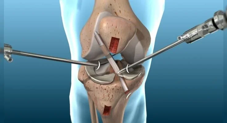 Knee-Arthoscopy