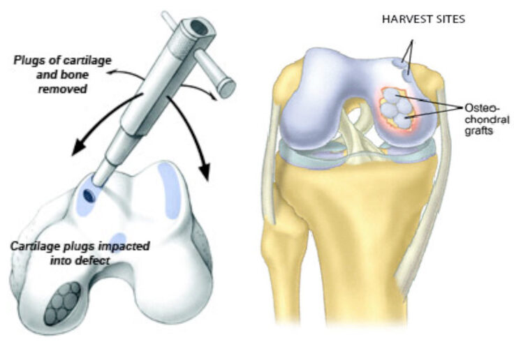 Mosaicplasty