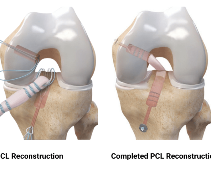 PCL-tear
